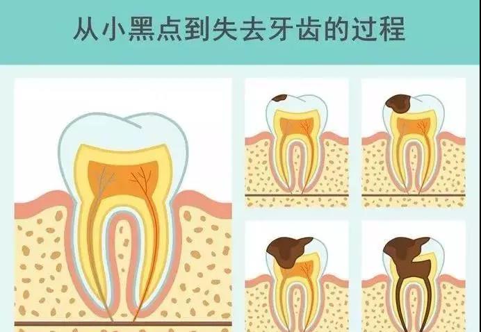 牙齿上的这个小黑点，你真的还要放任不管吗？